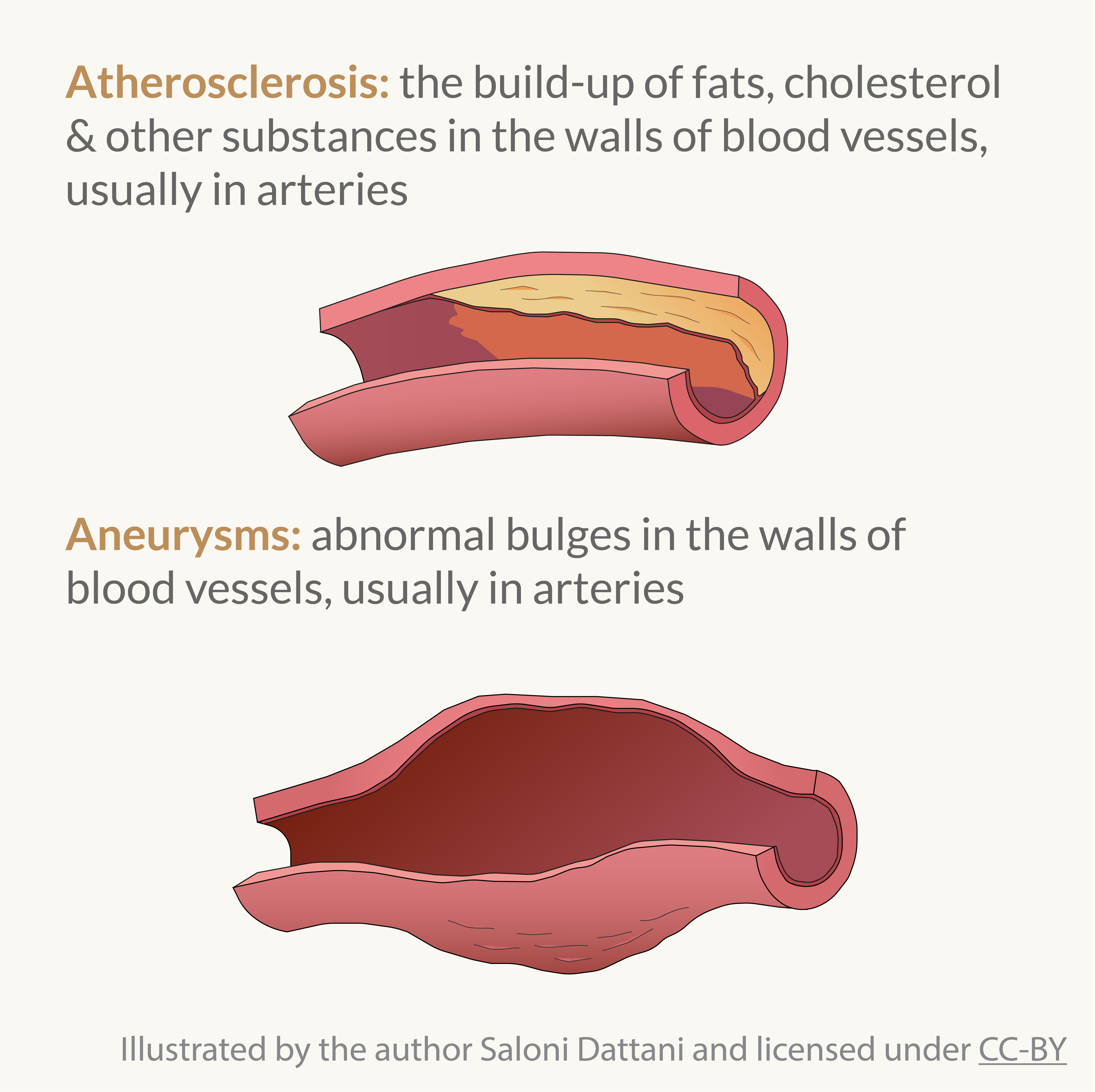Illustration of atherosclerosis and aneurysm