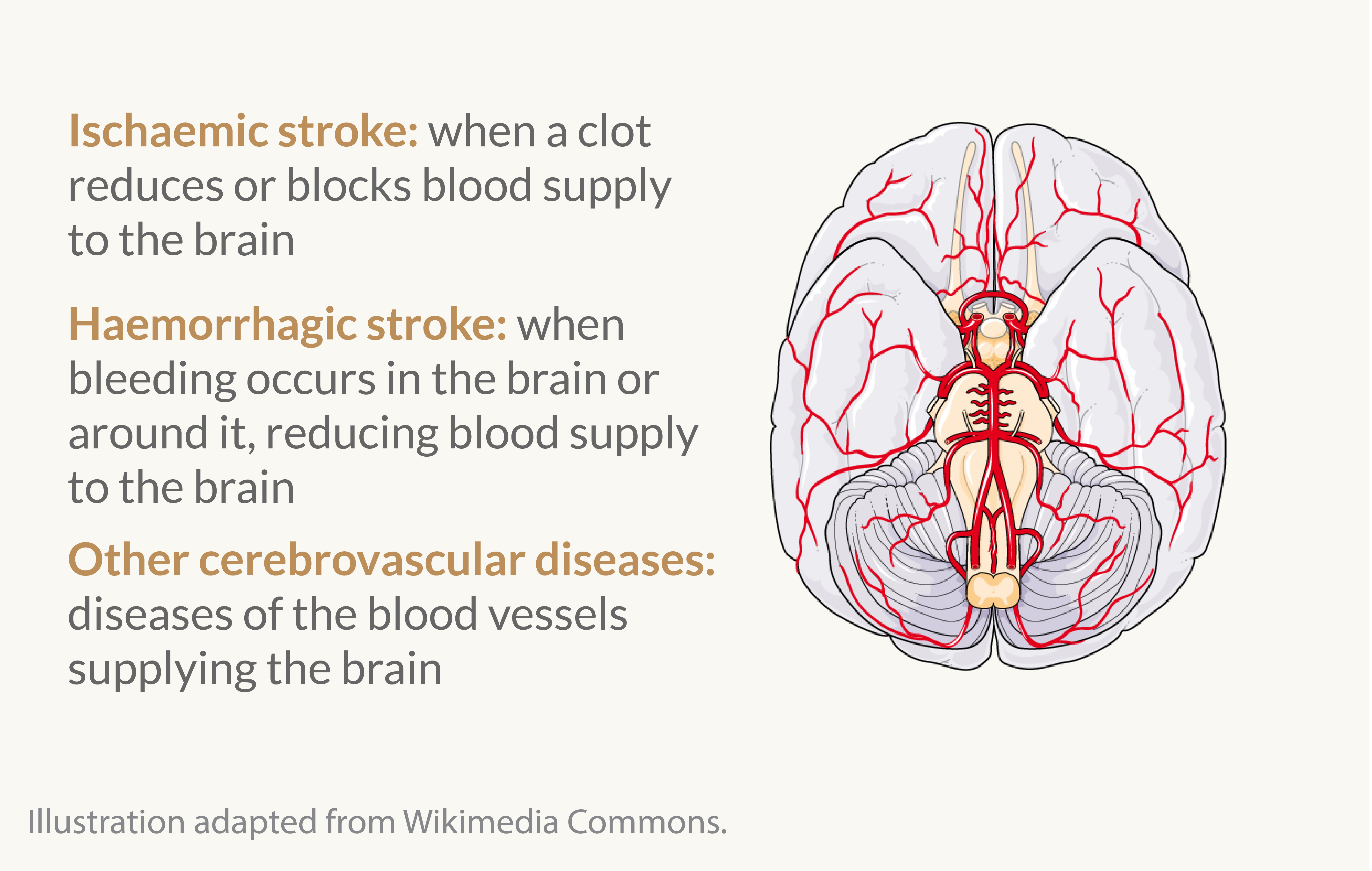 Illustration of cardiovascular diseases affecting the brain