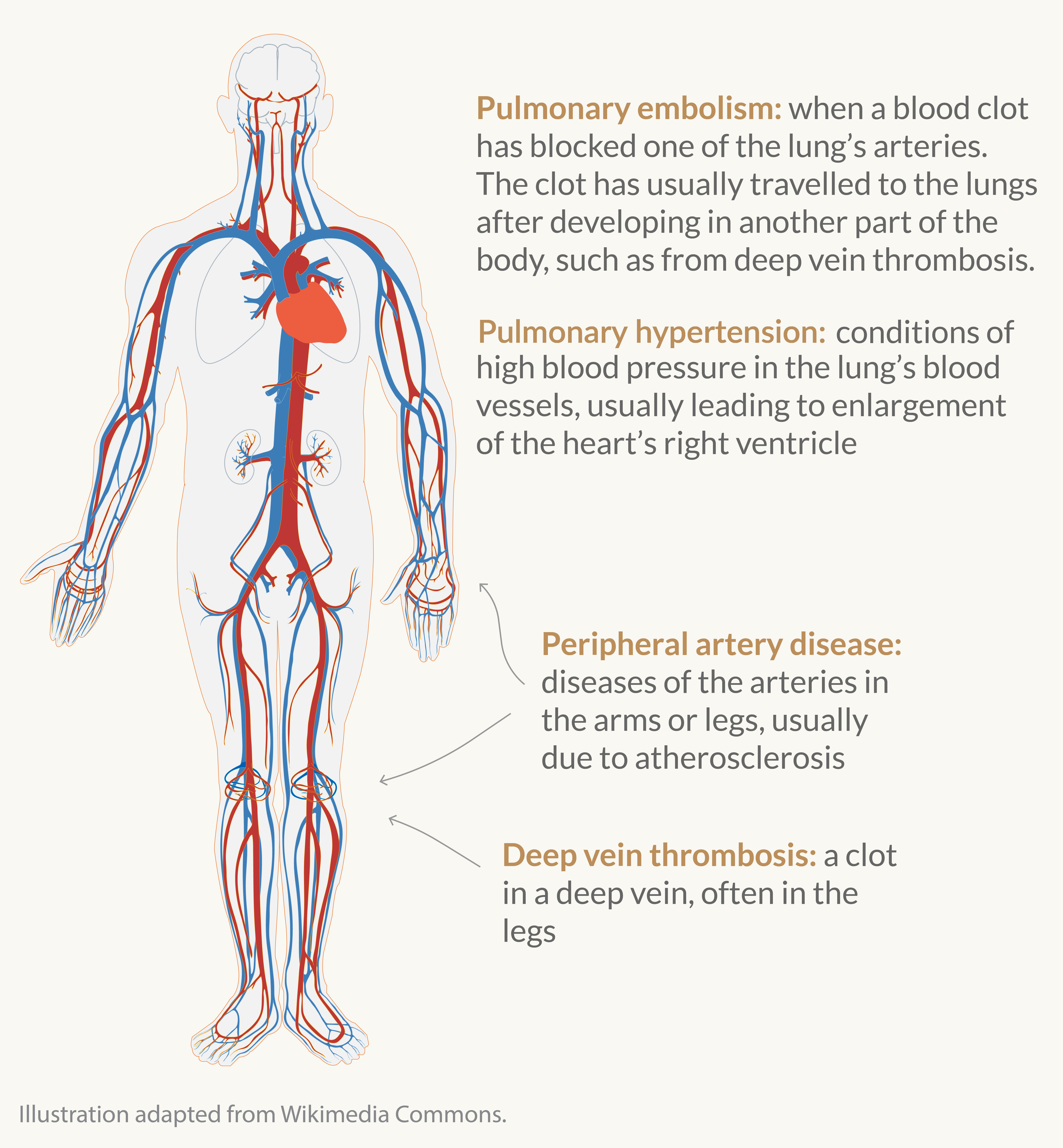 Illustration of cardiovascular diseases of the lungs and peripheral vessels